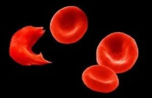 Doença é causada mutação genética da hemoglobina, tornando-a anormal e dando aos glóbulos vermelhos o formato de uma foice (imagem à esq.) (Reprodução )