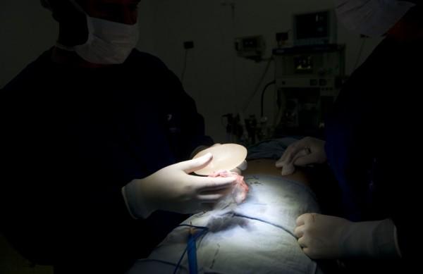 Cirurgião retira prótese mamária feita com um gel de silicone impróprio para uso médico (France Press)