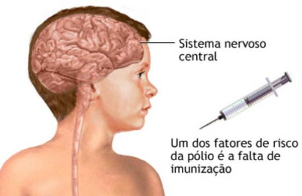 A vacina&ccedil;&atilde;o contra a polio previne efetivamente contra a poliomielite (Reprodução/ADAM)