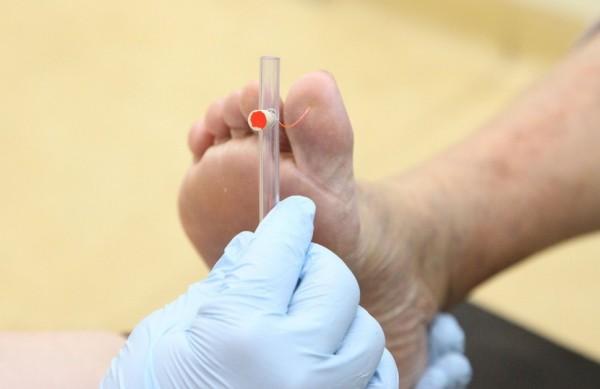 Aplica&ccedil;&atilde;o do teste de monofilamento, mais conhecido como teste do P&eacute;-Diab&eacute;tico ( Divulgação)