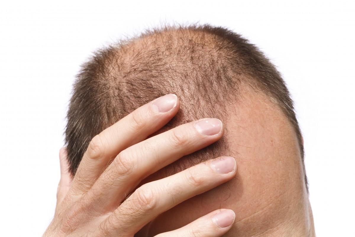 A substância contém um componente que tem como alvo uma proteína que atua como freio no crescimento do cabelo (Cedoc/RAC)