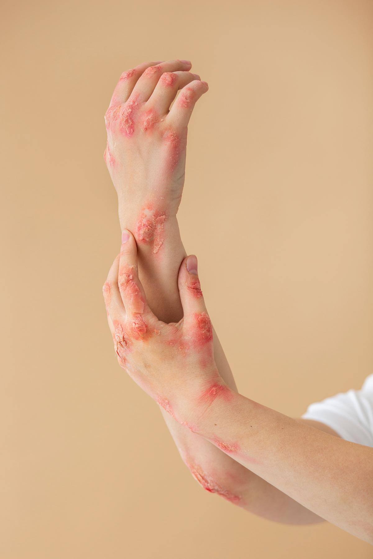 Herpes e resfriado são doenças comuns atreladas à baixa imunidade (FREEPICK)