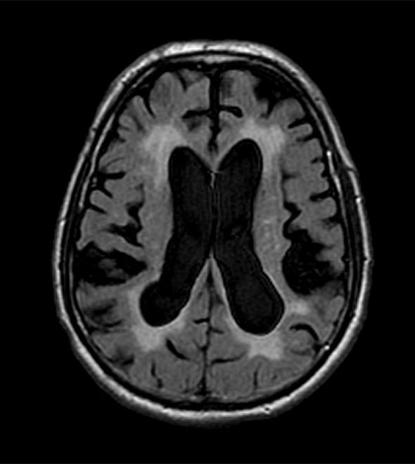 Doença confundida com Alzheimer e Parkinson pode ser curada com cirurgia (Reprodução)