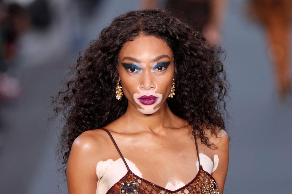 Winnie Harlow, 24 anos, a primeira top com vitiligo a fazer campanhas para grifes de luxo (Pinterest)