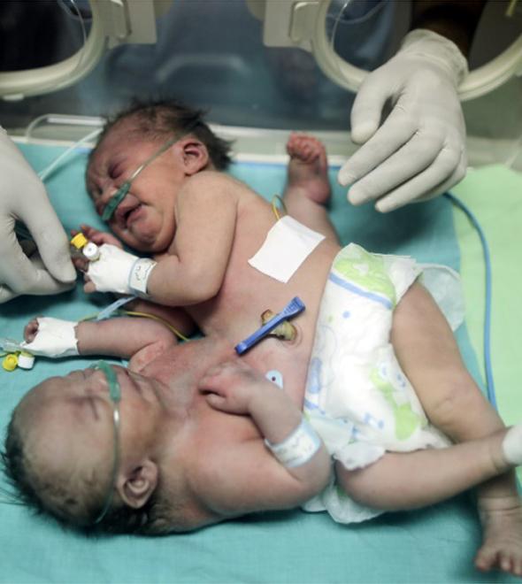 A separação de Farah e Haneen ocorreu no hospital King Abdullah de Riad, especializado em pediatria (AFP)