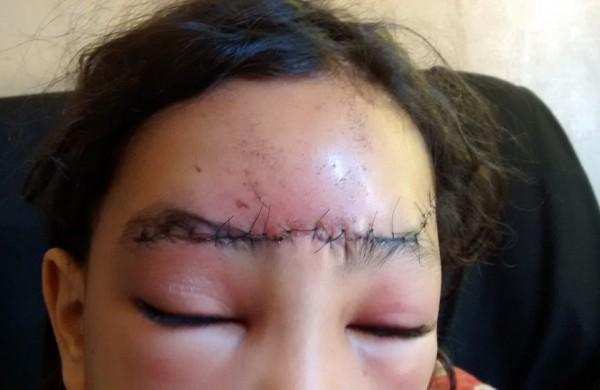 Menina recebeu cerca de 30 pontos na testa e dever&aacute; receber acompanhamento m&eacute;dico pelos pr&oacute;ximos meses ( Divulgação)