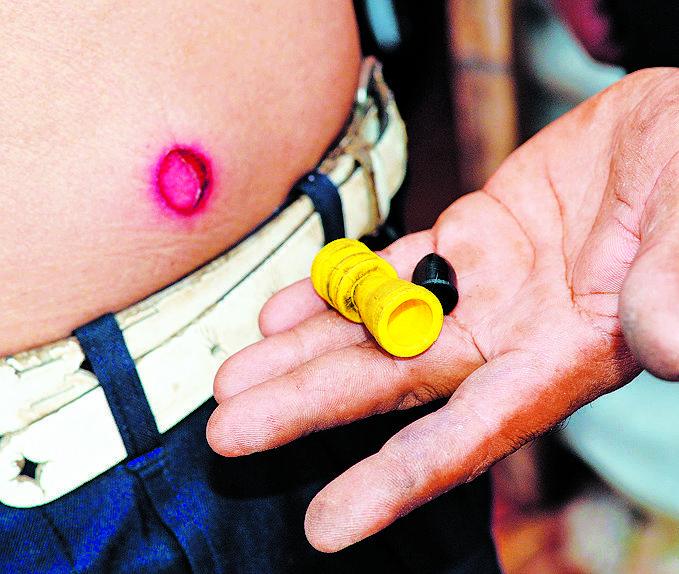 Idoso mostra ferimento na barriga provocado pela bala de borracha ( Antonio Trivelin/ Gazeta de Piracicaba )