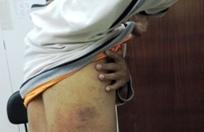 Paciente exibe marca de agress&atilde;o por monitor da cl&iacute;nica de Sorocaba  ( Divulgação)