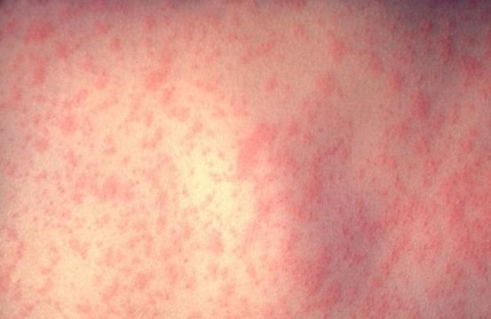 Uma em cada tr&ecirc;s pessoas que contraem o sarampo e n&atilde;o se vacinam desenvolve pneumonia ou inflama&ccedil;&atilde;o do c&eacute;rebro ( Reprodução)