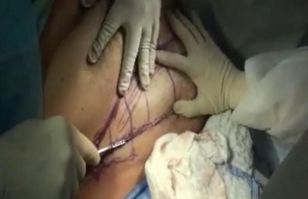 Médico corta a própria barriga com bisturi para procedimento cirúrgico (Reprodução)